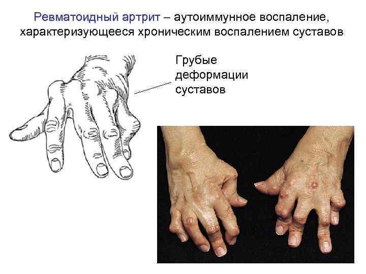 Ревматоидный артрит – аутоиммунное воспаление, характеризующееся хроническим воспалением суставов Грубые деформации суставов 