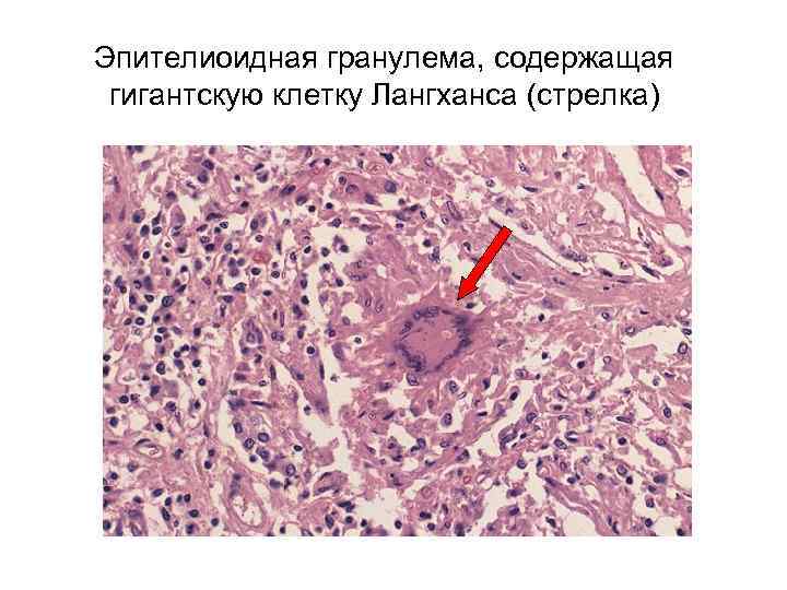 Эпителиоидная гранулема, содержащая гигантскую клетку Лангханса (стрелка) 