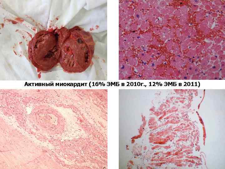 Активный миокардит (16% ЭМБ в 2010 г. , 12% ЭМБ в 2011) 