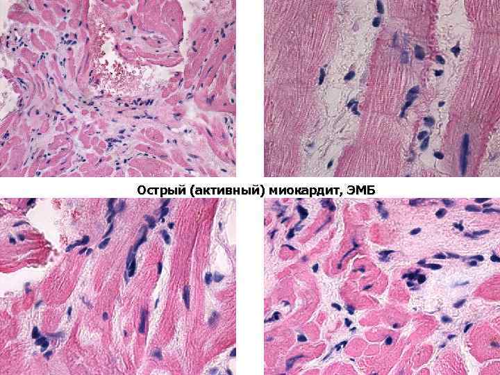 Острый (активный) миокардит, ЭМБ 