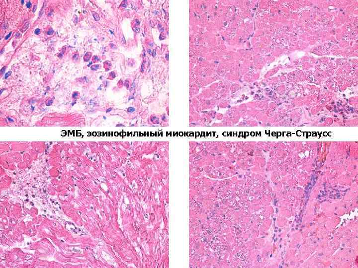 ЭМБ, эозинофильный миокардит, синдром Черга-Страусс 