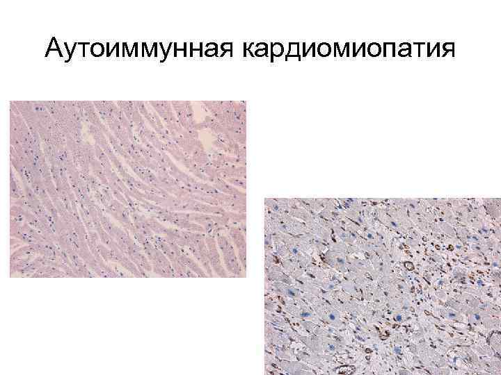 Аутоиммунная кардиомиопатия 