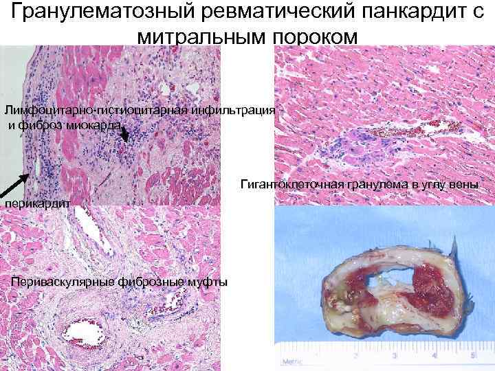 Гранулематозный ревматический панкардит с митральным пороком Лимфоцитарно-гистиоцитарная инфильтрация и фиброз миокарда Гигантоклеточная гранулема в