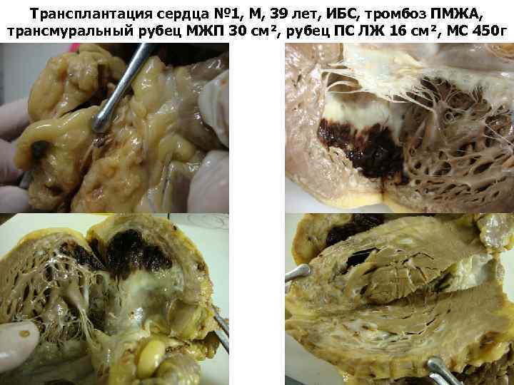 Трансплантация сердца № 1, М, 39 лет, ИБС, тромбоз ПМЖА, трансмуральный рубец МЖП 30