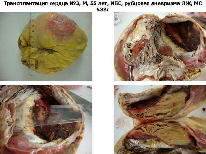 Трансплантация сердца № 3, М, 55 лет, ИБС, рубцовая аневризма ЛЖ, МС 588 г