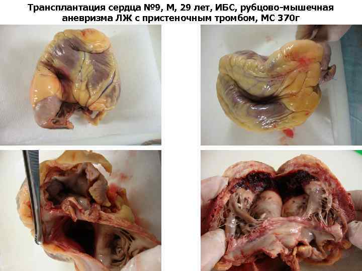 Трансплантация сердца № 9, М, 29 лет, ИБС, рубцово-мышечная аневризма ЛЖ с пристеночным тромбом,