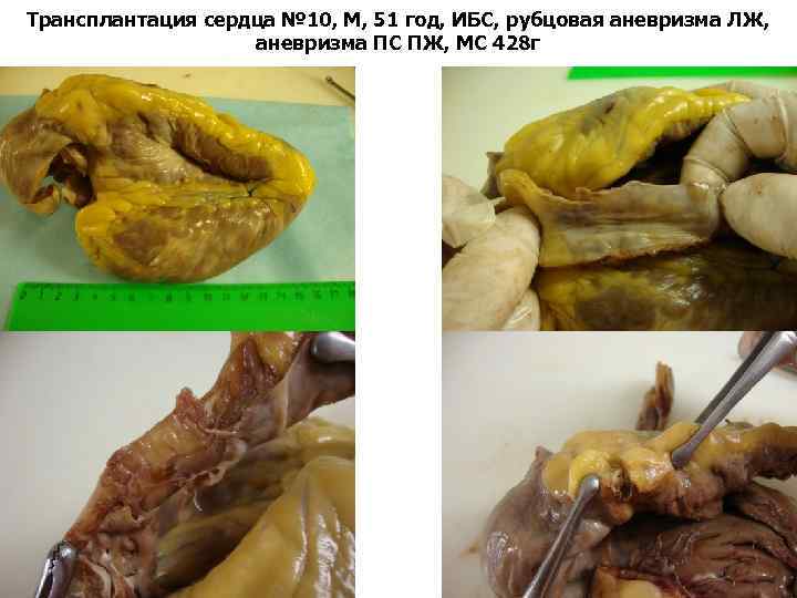 Трансплантация сердца № 10, М, 51 год, ИБС, рубцовая аневризма ЛЖ, аневризма ПС ПЖ,