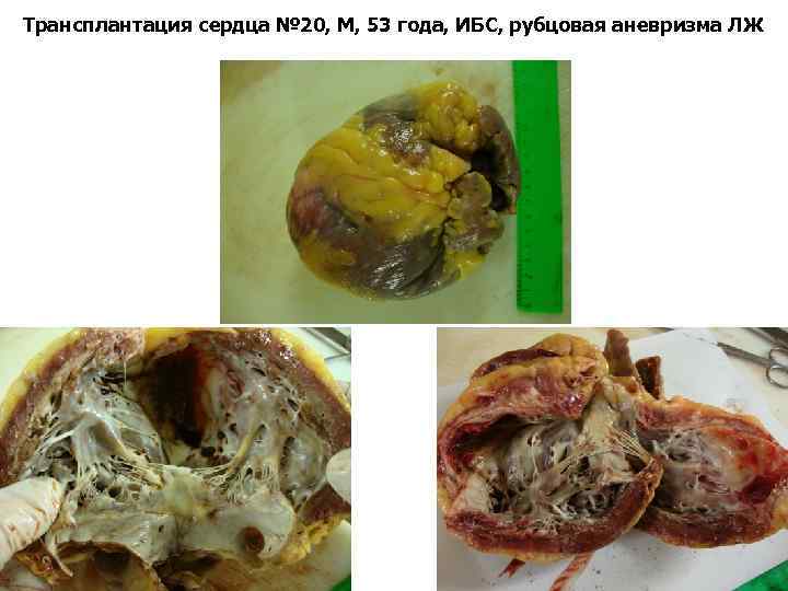 Трансплантация сердца № 20, М, 53 года, ИБС, рубцовая аневризма ЛЖ 