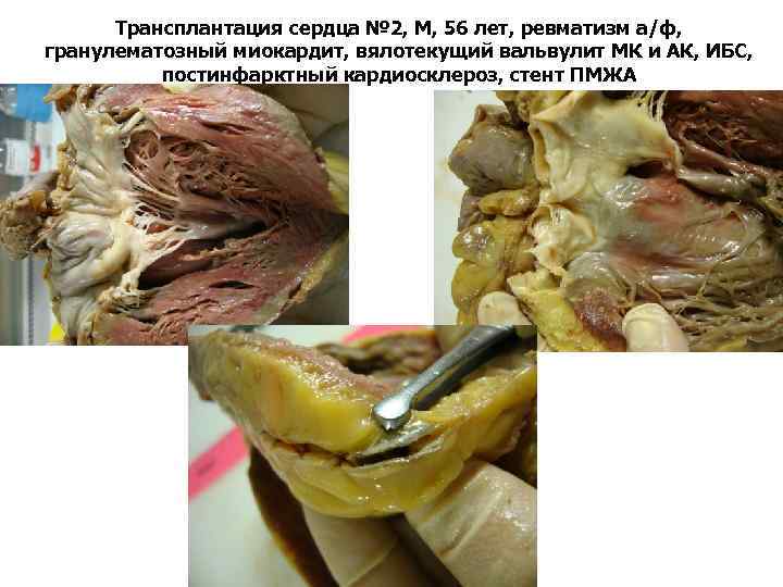 Трансплантация сердца № 2, М, 56 лет, ревматизм а/ф, гранулематозный миокардит, вялотекущий вальвулит МК