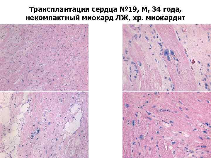 Трансплантация сердца № 19, М, 34 года, некомпактный миокард ЛЖ, хр. миокардит 