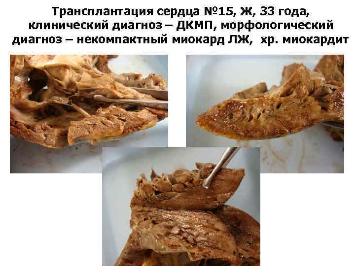 Трансплантация сердца № 15, Ж, 33 года, клинический диагноз – ДКМП, морфологический диагноз –