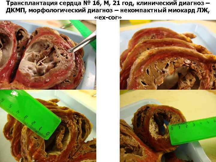 Трансплантация сердца № 16, М, 21 год, клинический диагноз – ДКМП, морфологический диагноз –