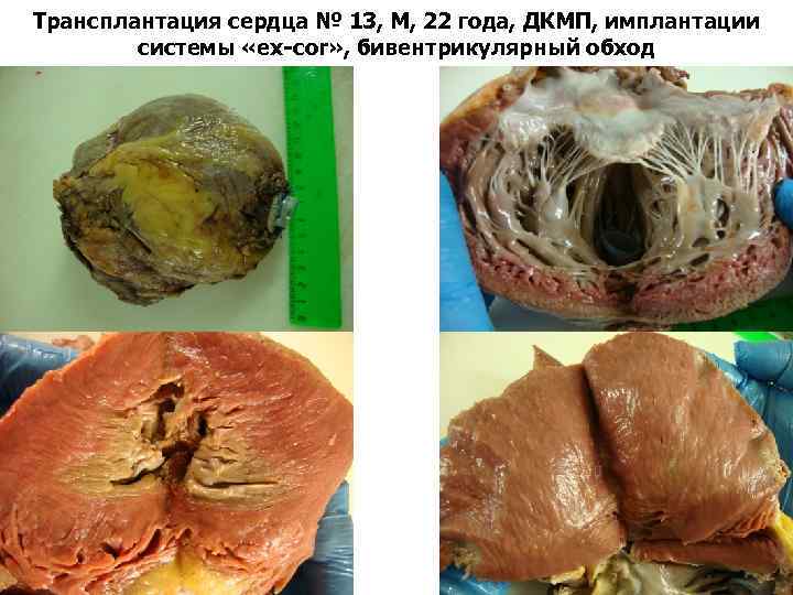 Трансплантация сердца № 13, М, 22 года, ДКМП, имплантации системы «ex-cor» , бивентрикулярный обход