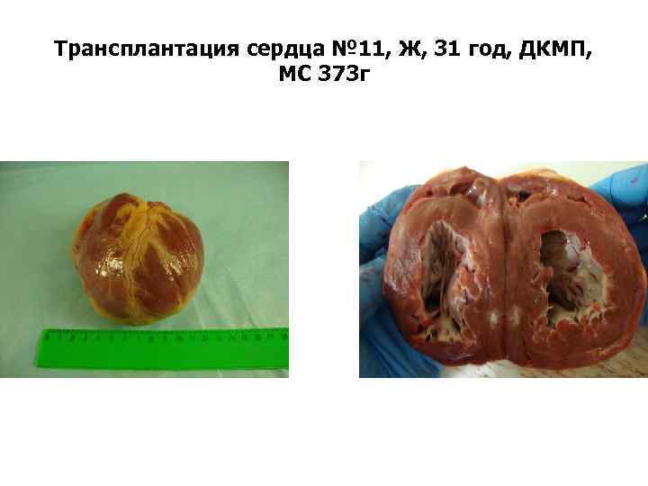 Трансплантация сердца № 11, Ж, 31 год, ДКМП, МС 373 г 