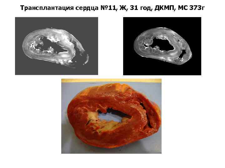 Трансплантация сердца № 11, Ж, 31 год, ДКМП, МС 373 г 