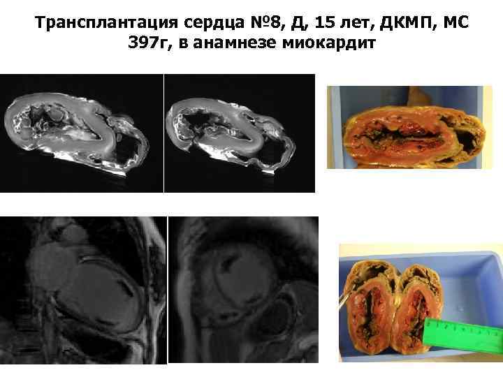 Трансплантация сердца № 8, Д, 15 лет, ДКМП, МС 397 г, в анамнезе миокардит