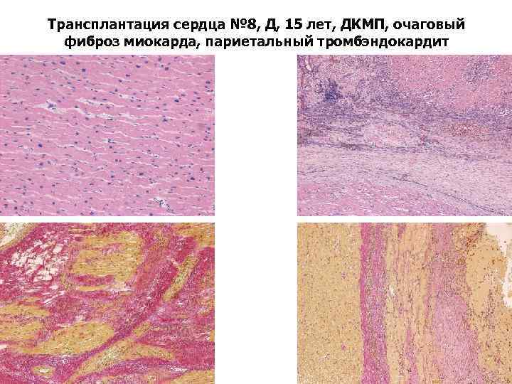 Трансплантация сердца № 8, Д, 15 лет, ДКМП, очаговый фиброз миокарда, париетальный тромбэндокардит 