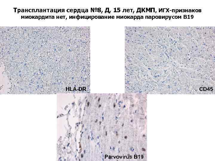 Трансплантация сердца № 8, Д, 15 лет, ДКМП, ИГХ-признаков миокардита нет, инфицирование миокарда паровирусом
