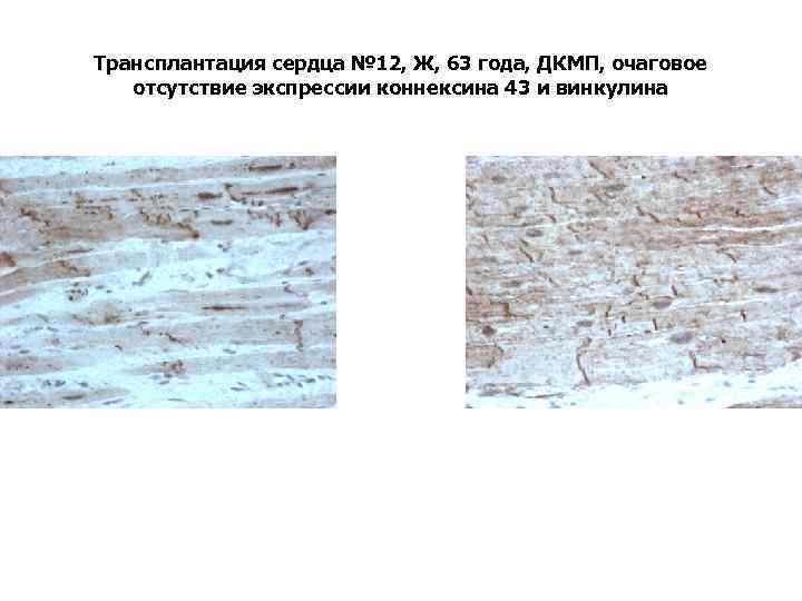 Трансплантация сердца № 12, Ж, 63 года, ДКМП, очаговое отсутствие экспрессии коннексина 43 и
