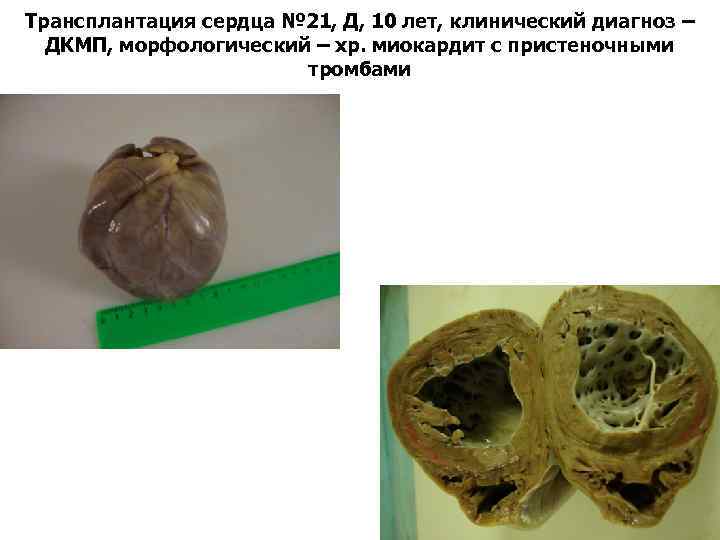Трансплантация сердца № 21, Д, 10 лет, клинический диагноз – ДКМП, морфологический – хр.