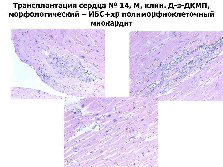 Трансплантация сердца № 14, М, клин. Д-з-ДКМП, морфологический – ИБС+хр полиморфноклеточный миокардит 