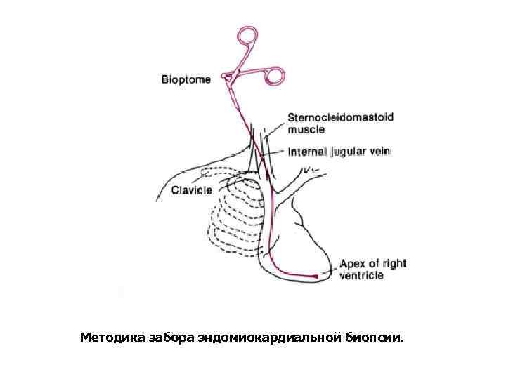 Методика забора эндомиокардиальной биопсии. 