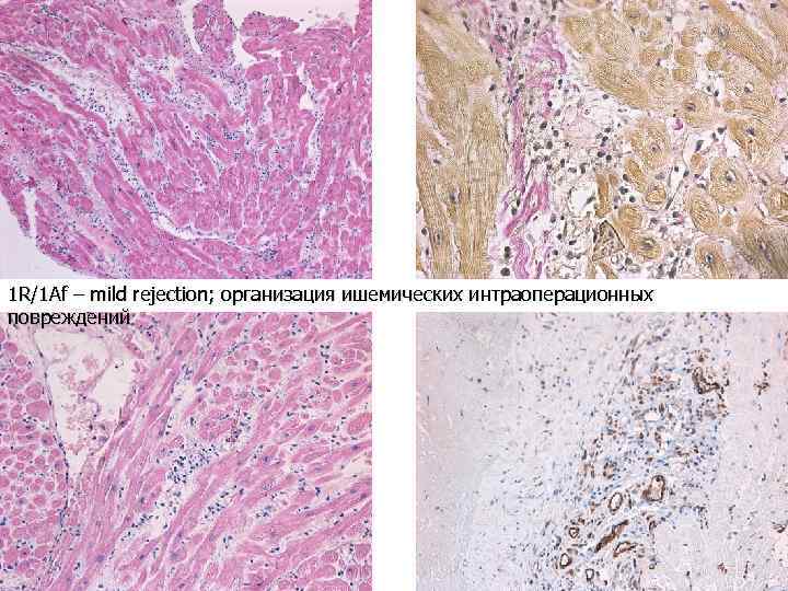1 R/1 Аf – mild rejection; организация ишемических интраоперационных повреждений 