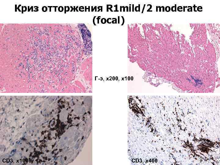 Криз отторжения R 1 mild/2 moderate (focal) Г-э, х200, х100 CD 3, х1000 CD