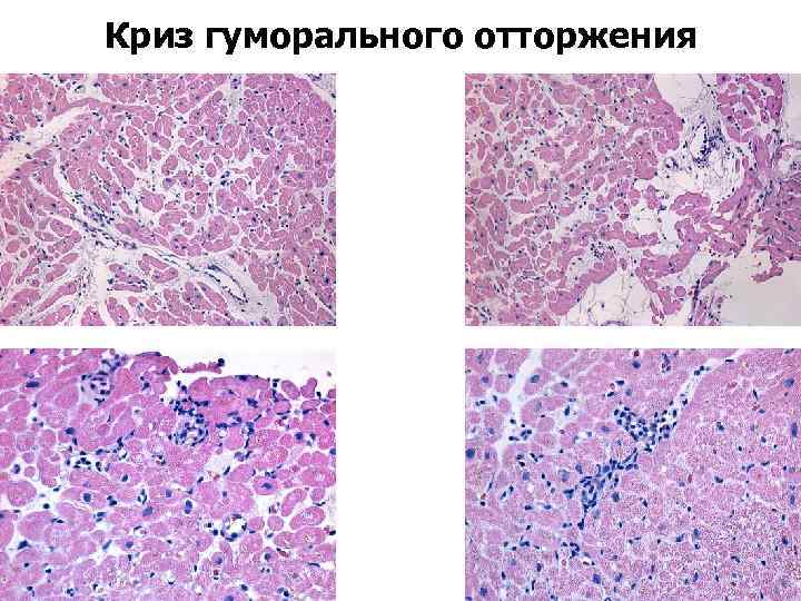 Криз гуморального отторжения 