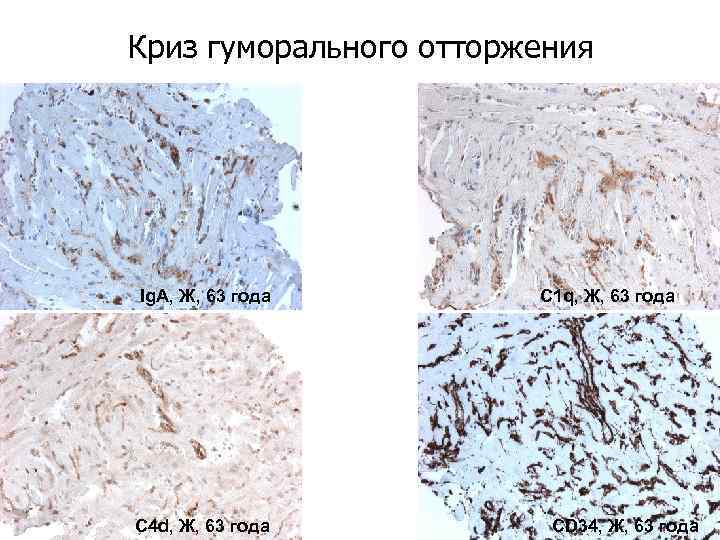 Криз гуморального отторжения Ig. A, Ж, 63 года C 4 d, Ж, 63 года