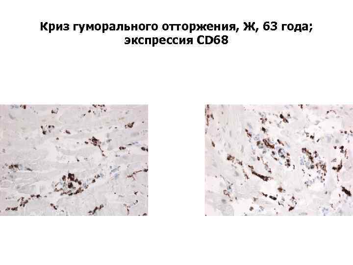 Криз гуморального отторжения, Ж, 63 года; экспрессия CD 68 