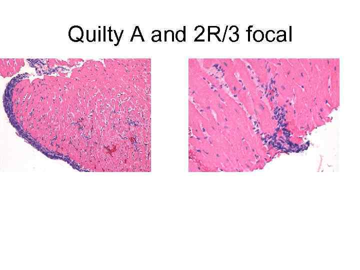 Quilty A and 2 R/3 focal 