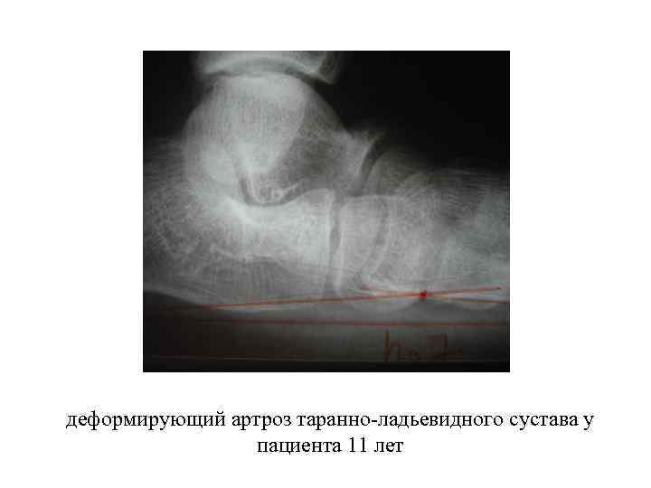 Таранно ладьевидный остеоартроз 1 степени