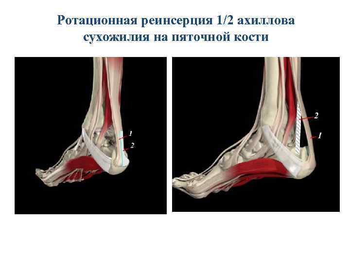 Тендиноз ахилловых сухожилий что это. Инсерционный тендинит ахиллова сухожилия. Тендинит ахиллова сухожилия рентген. Инсерционный тендинит ахиллова сухожилия рентген. Микроразрывы ахиллова сухожилия.