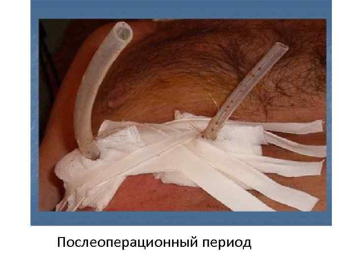 Послеоперационный период 