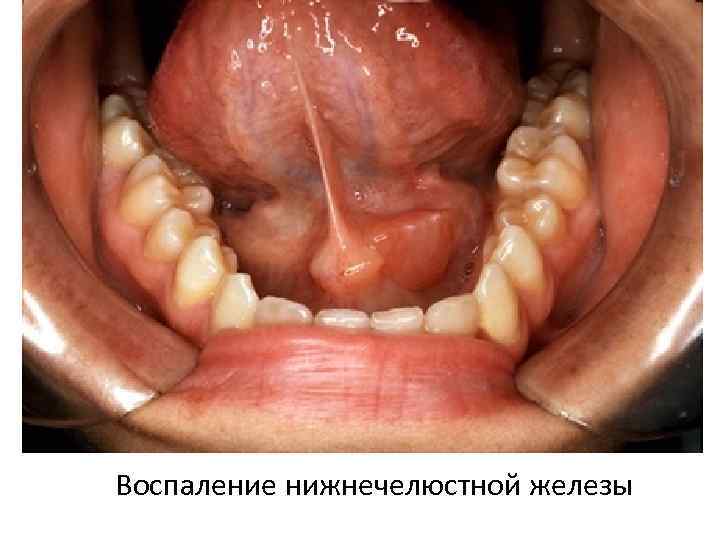 Воспаление нижнечелюстной железы 