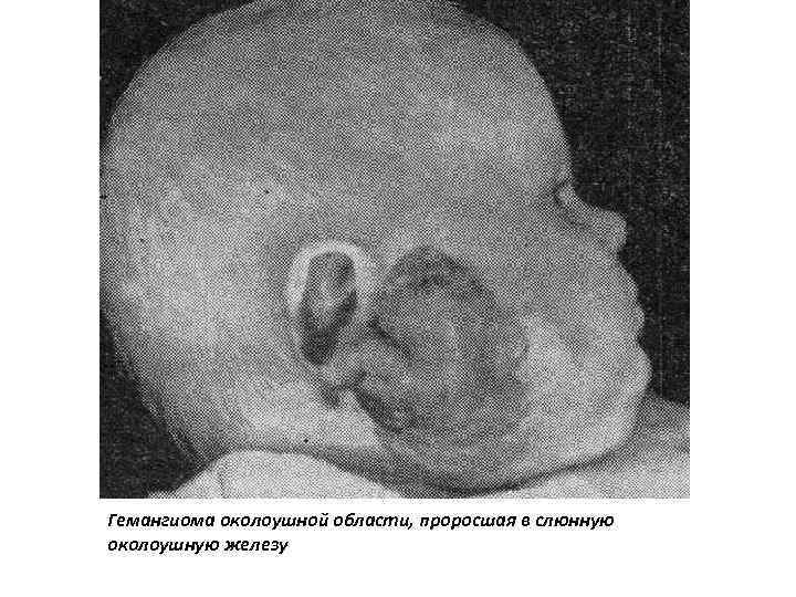 Гемангиома околоушной области, проросшая в слюнную околоушную железу 
