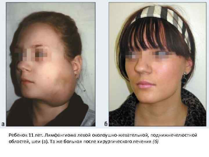 Ребенок 11 лет. Лимфангиома левой околоушно-жевательной, поднижнечелюстной областей, шеи (а). Та же больная после