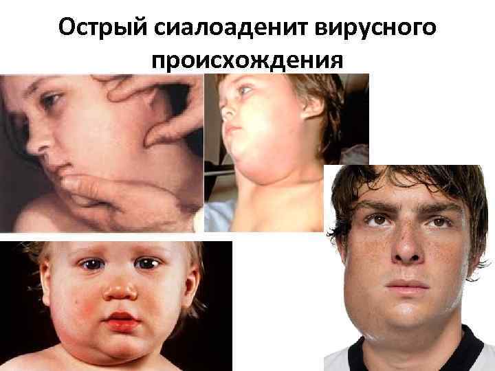 Острый сиалоаденит вирусного происхождения 