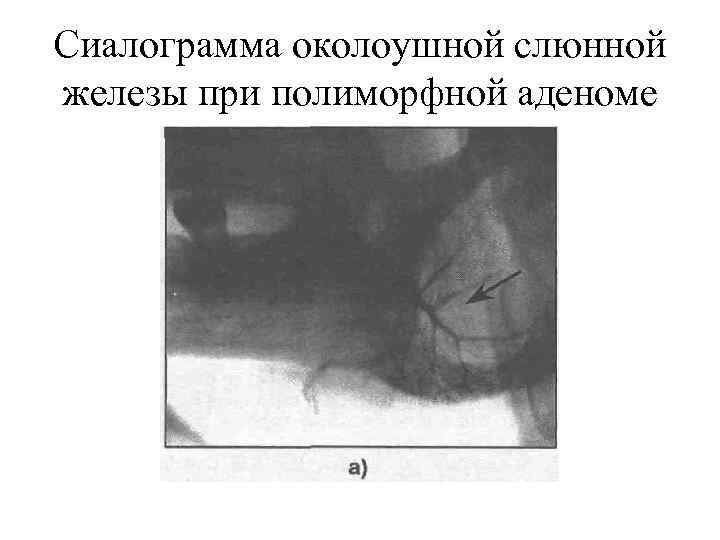 Сиалограмма околоушной слюнной железы при полиморфной аденоме 