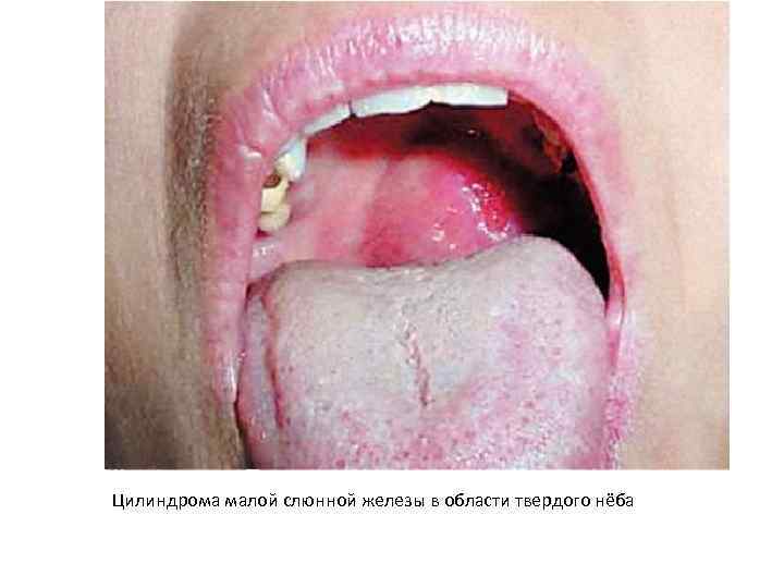 Цилиндрома малой слюнной железы в области твердого нёба 