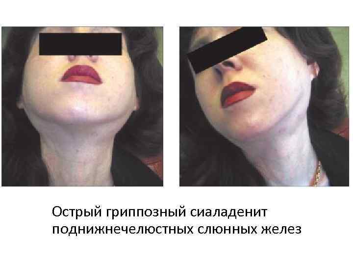 Острый гриппозный сиаладенит поднижнечелюстных слюнных желез 