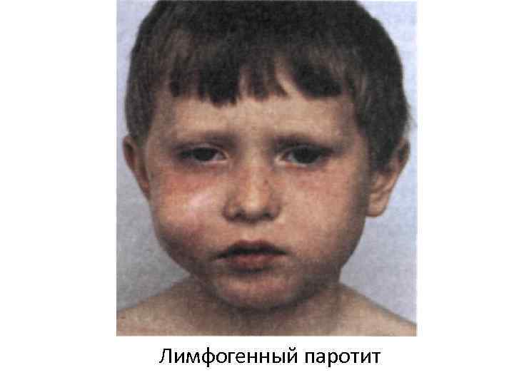 Лимфогенный паротит 