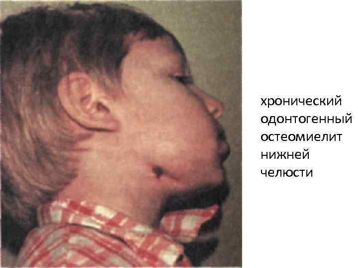 хронический одонтогенный остеомиелит нижней челюсти 