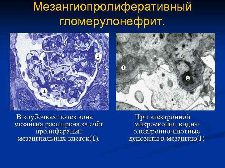 Морфологическая картина гломерулонефрита