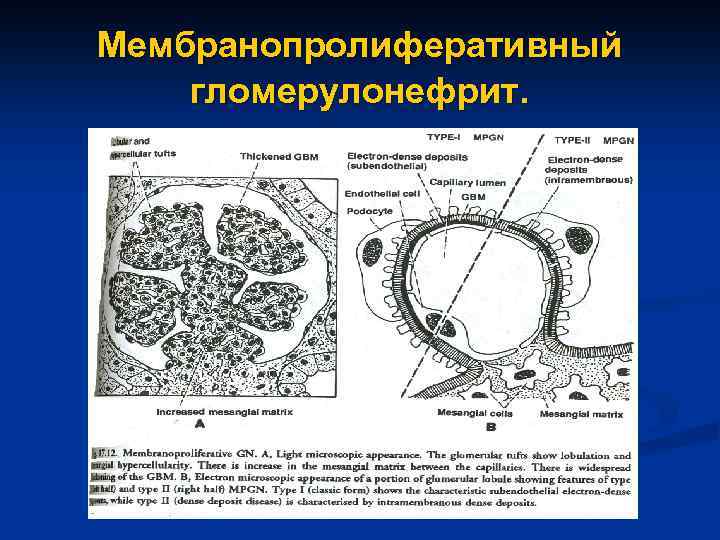 Мембранопролиферативный гломерулонефрит. 