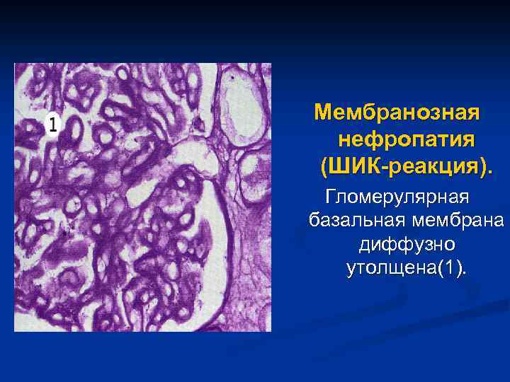 Мембранозная нефропатия (ШИК-реакция). Гломерулярная базальная мембрана диффузно утолщена(1). 