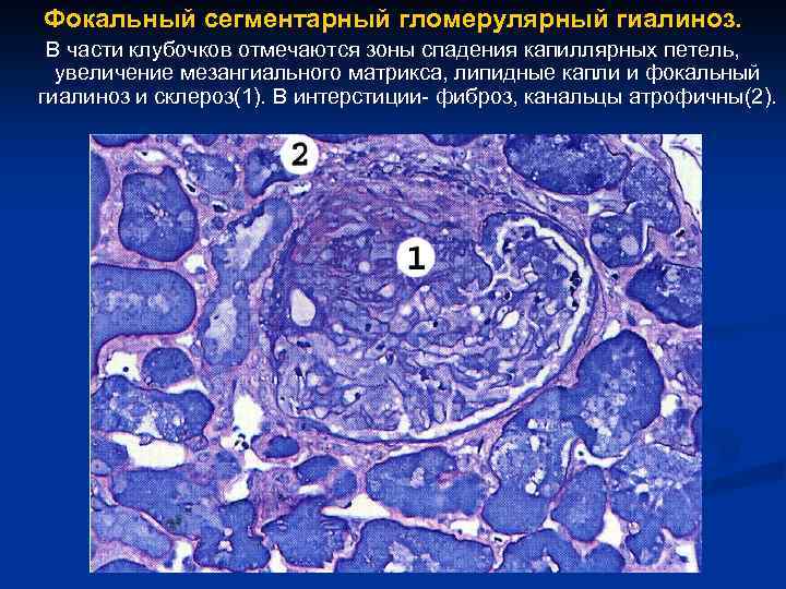 Фокальный сегментарный гломерулярный гиалиноз. В части клубочков отмечаются зоны спадения капиллярных петель, увеличение мезангиального