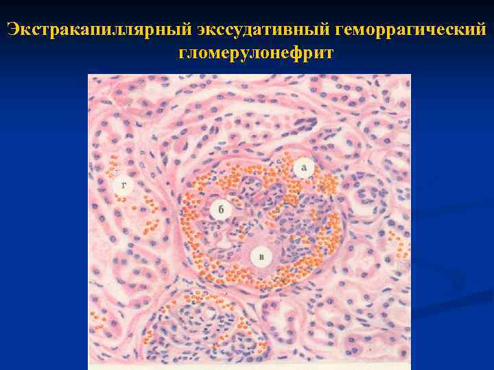 Экстракапиллярный экссудативный геморрагический гломерулонефрит 