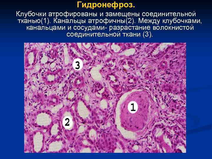 Гидронефроз. Клубочки атрофированы и замещены соединительной тканью(1). Канальцы атрофичны(2). Между клубочками, канальцами и сосудами-